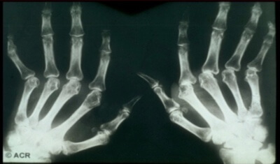 Issues in Rheumatology | Cane and Able Stroke Recovery Group meeting